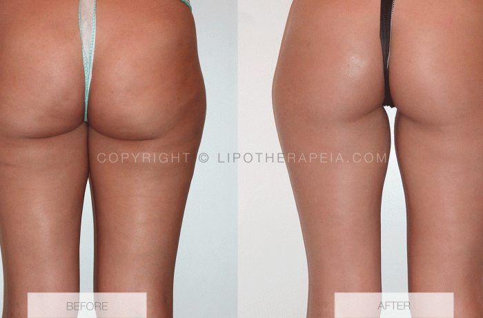 Real-before-and-after-cellulite-pictures
